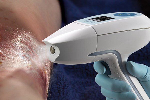 Treatment with Ultramist Sanuwave